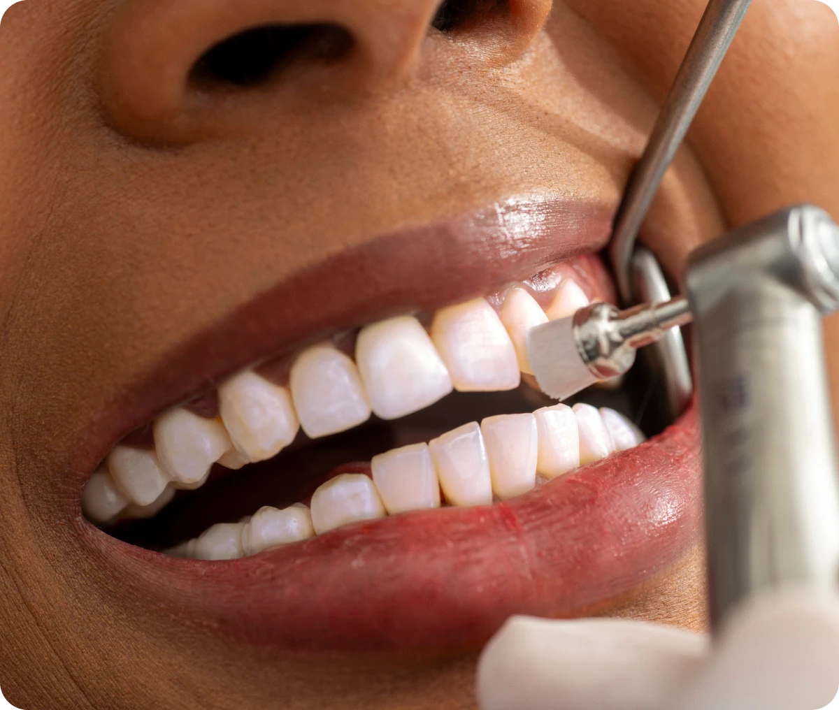 Dental cleaning procedure close-up