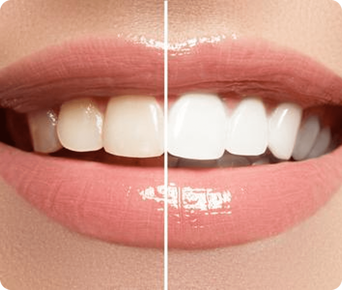 Half-whitened teeth showing dental results