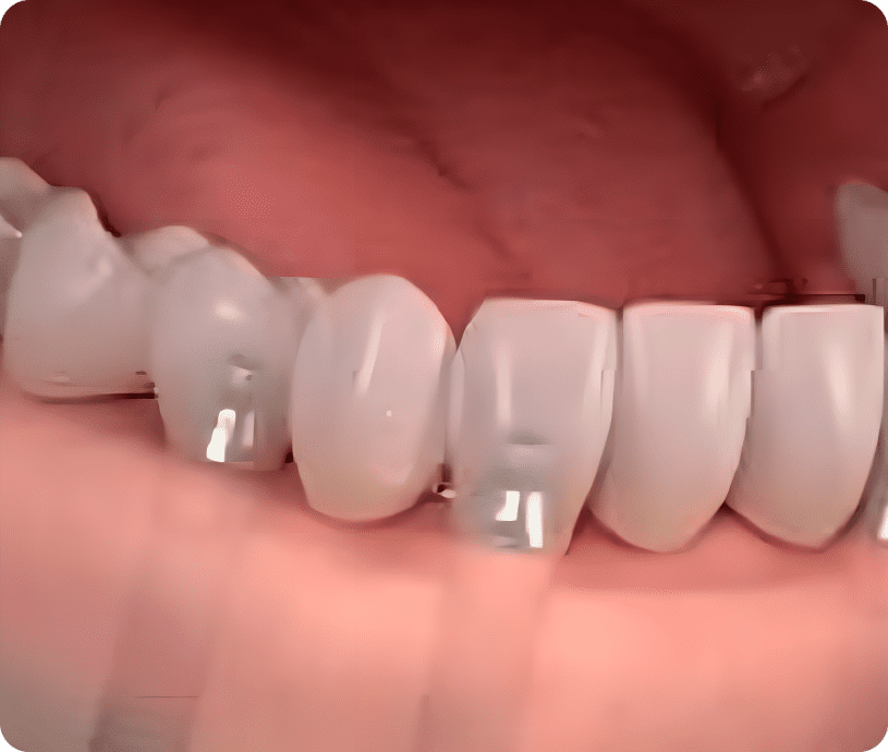 White teeth with veneers applied