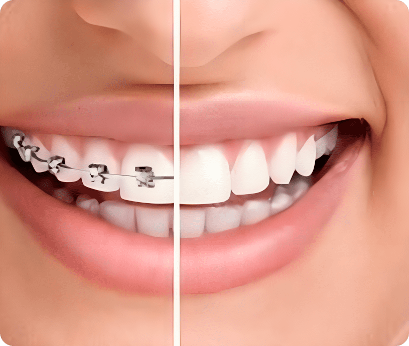 Braces before and after comparison